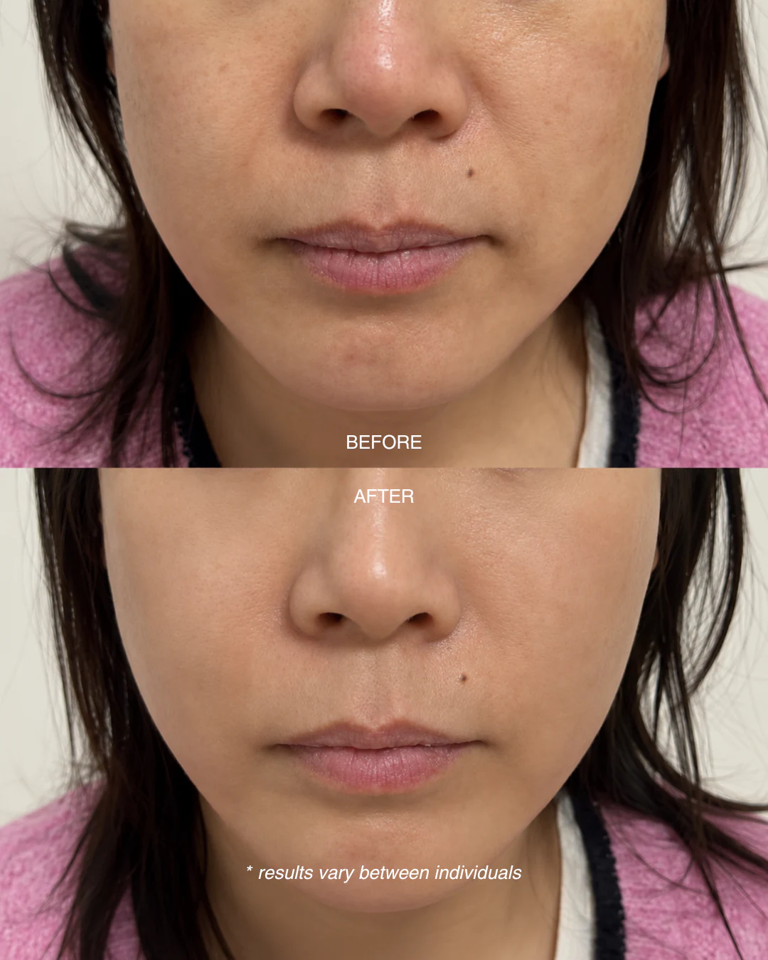 Before and after an RF Lifting Facial showing a more defined jawline