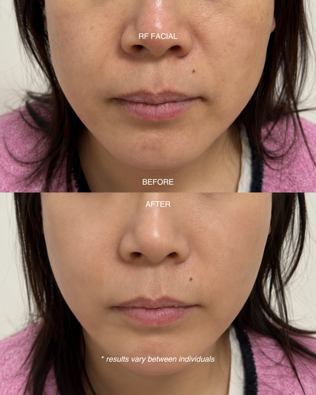 RF Facial