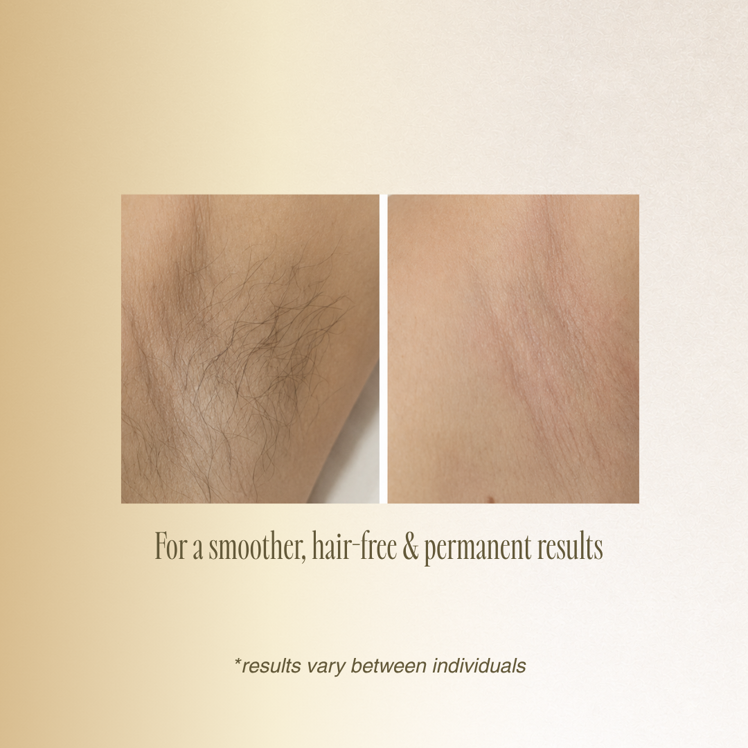 OPT Brazilian Hair Removal