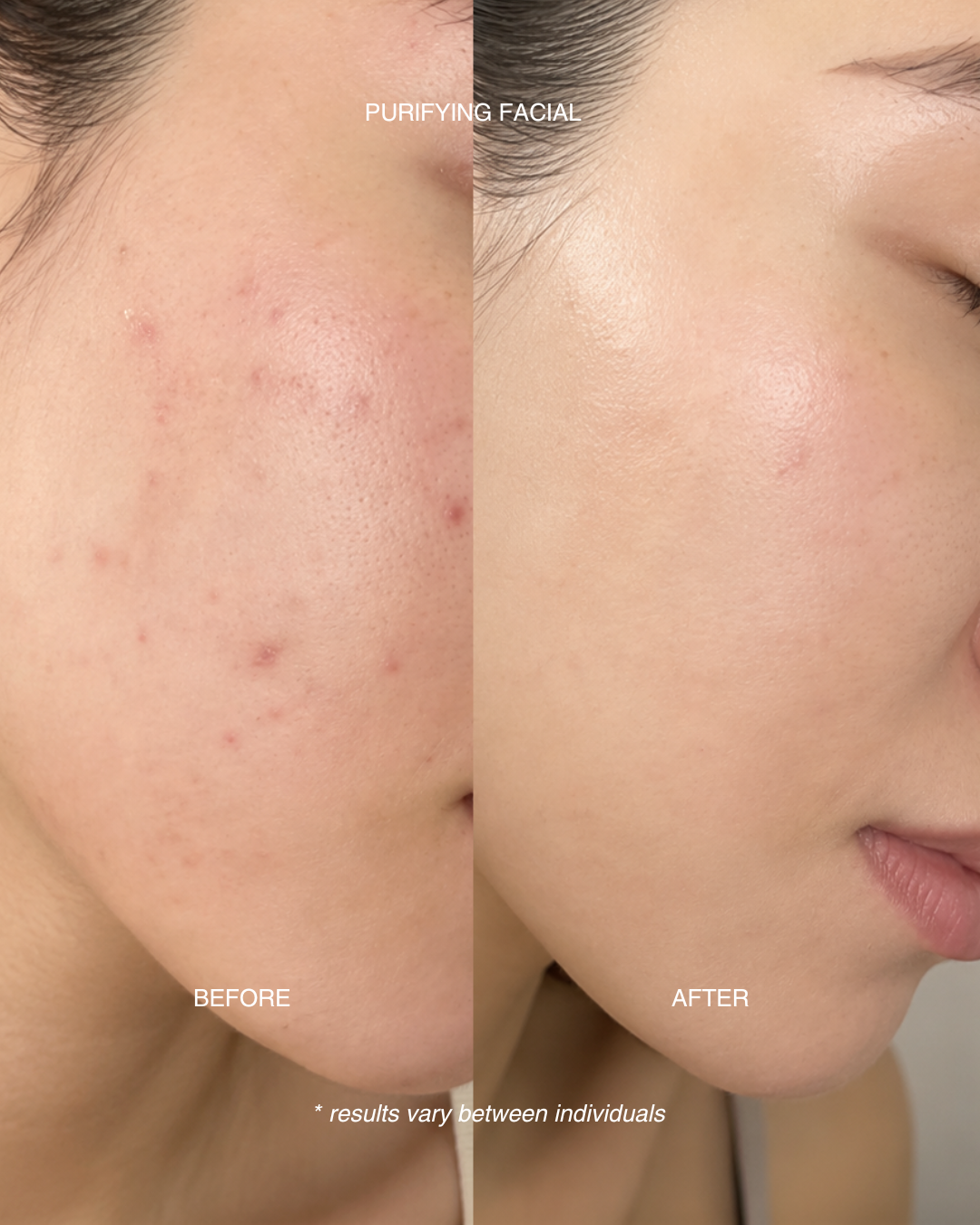 Purifying Facial